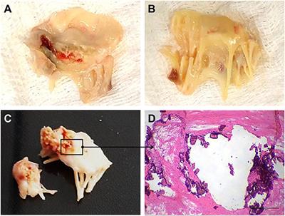 Rheumatic Heart Valve Disease Pathophysiology and Underlying Mechanisms